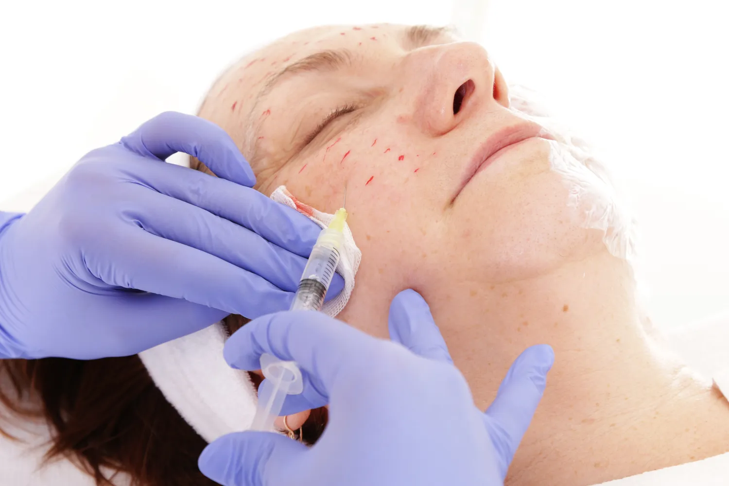 Jak pozbyć się zmarszczek pod oczami medycyna estetyczna?