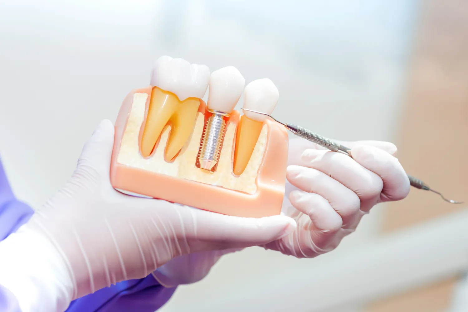 Wszystko co musisz wiedzieć o implantach zębowych